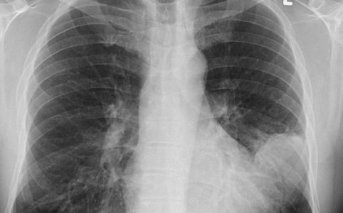 Lungenentzündung im Röntgenbild