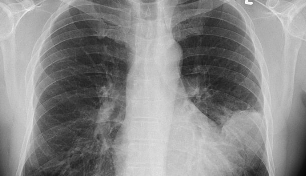 Lungenentzündung im Röntgenbild