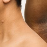 Nahaufnahme eines menschlichen Halses mit mehreren Hautanhängseln (Skin Tags) sowie einer dunklen, samtartigen Verfärbung in der Achselhöhle (Acanthosis nigricans) als mögliche Anzeichen für Insulinresistenz.